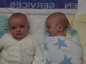 Pyloric Stenosis; the weight gain was different in my twins...